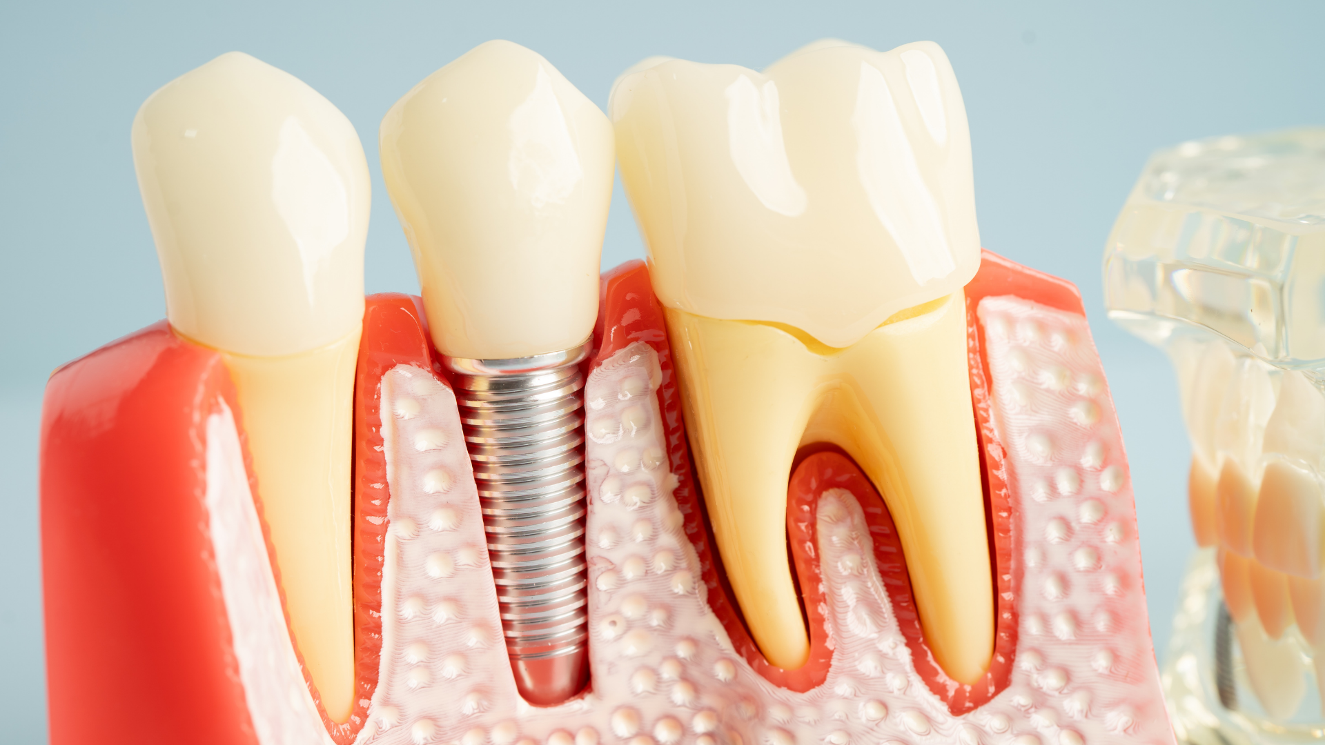 Modelo de implante dentário