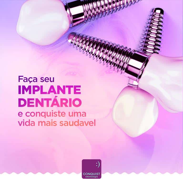 O Que São Implantes Dentários L Conquist Odontologia 9500