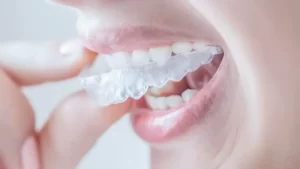 aparelho invisalign