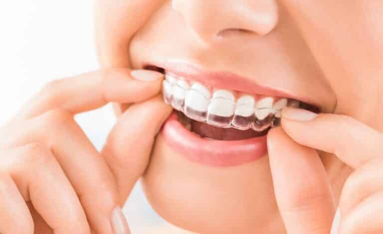 Aparelho Invisalign Saiba Tudo Sobre Esse Tipo De Aparelho